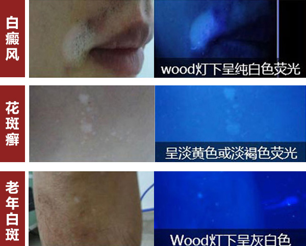 孩子身上有白斑是什么回事?