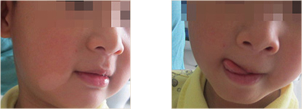 赣州小孩子长了白癜风该怎么治疗好?