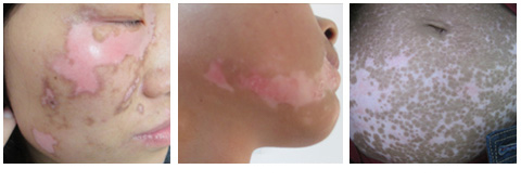 赣州平时生活中应该如何正常看待白癜风?