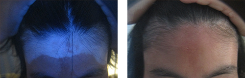 赣州外伤所引发的白癜风会有哪些症状呢?