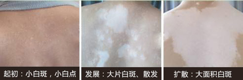  全南背部白癜风的危害你了解多少呢?  