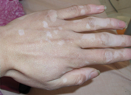 手部患上白斑病的缘由是什么呢