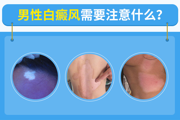 男性身上出现白癜风要注意什么?