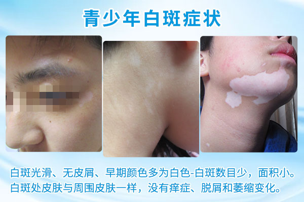 青少年白癜风的早期症状有哪些?