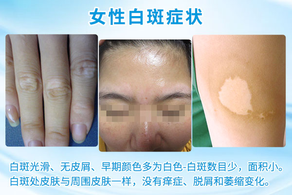 阜阳颍上早期白癜风的女性症状到底是什