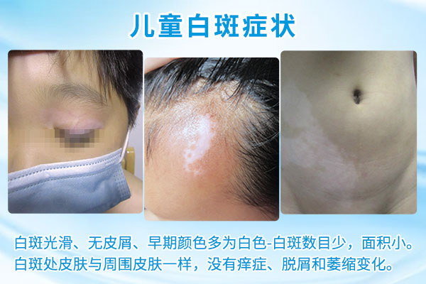 赣州小儿白癜风症状有哪些?