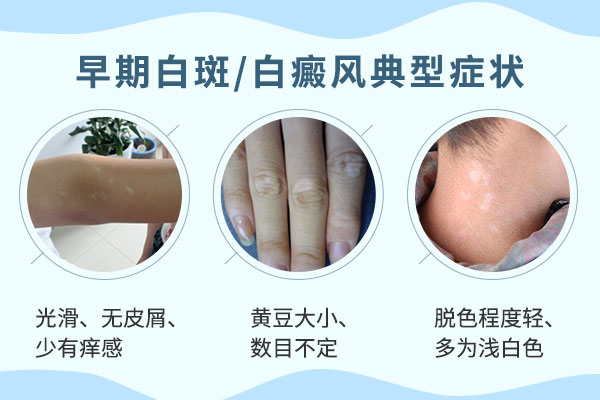 手臂白斑是不是白癜风，到底该怎么诊断呢?