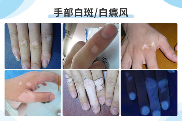阜阳临泉手臂上长白斑是什么情况?