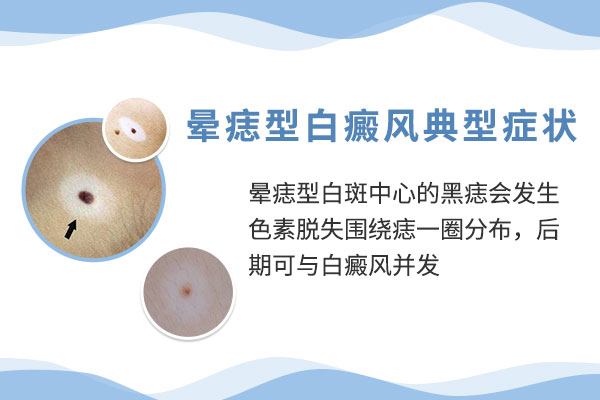 白癜风的早期症状是什么?