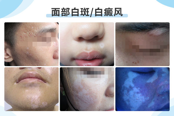 赣州如何做是能护理好面部白癜风
