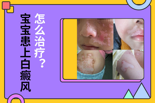 为什么白癜风患儿选择在小的时候接受治疗?