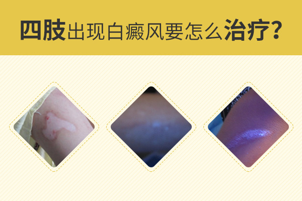 阜阳临泉为什么肢端型白癜风恢复的速度慢呢?