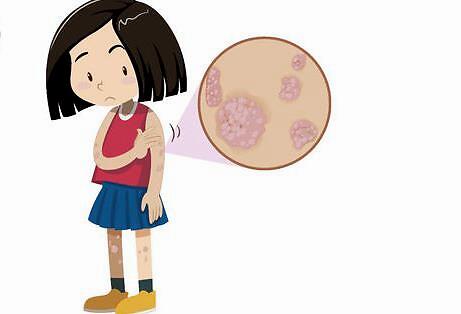 如何治疗女性银屑病?