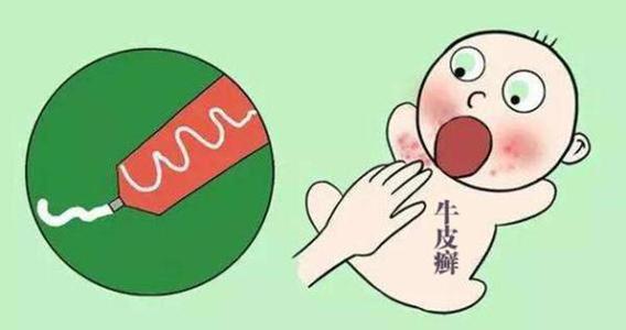 小孩脸上有银屑病怎么治疗?
