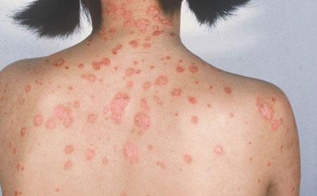 银屑病的治疗费用是多少?