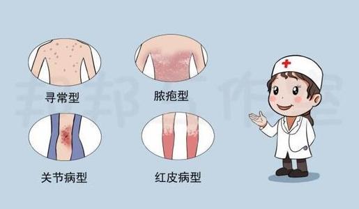 银屑病的不同症状有哪些?